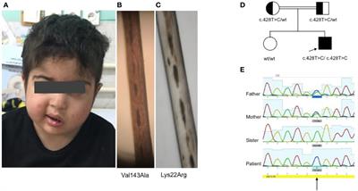 Griscelli Syndrome Type 2 Sine Albinism: Unraveling Differential RAB27A Effector Engagement